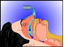 CPAP